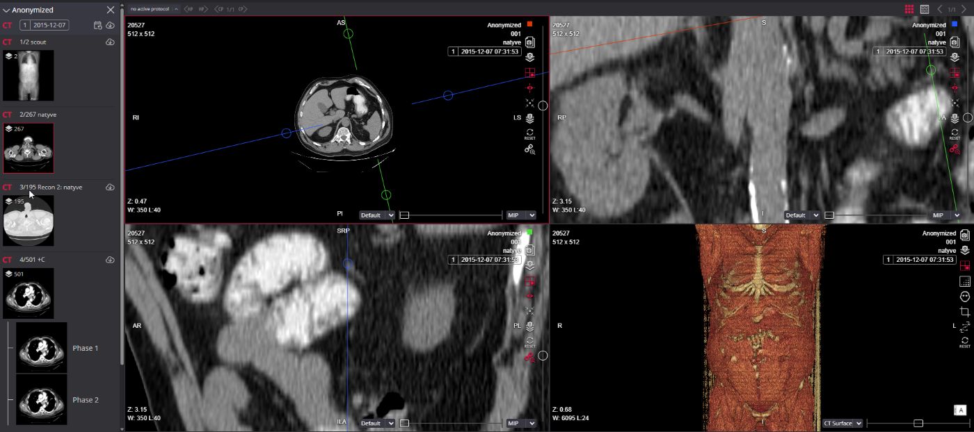 MedDream Dicom Viewer MPR Sync Zoom